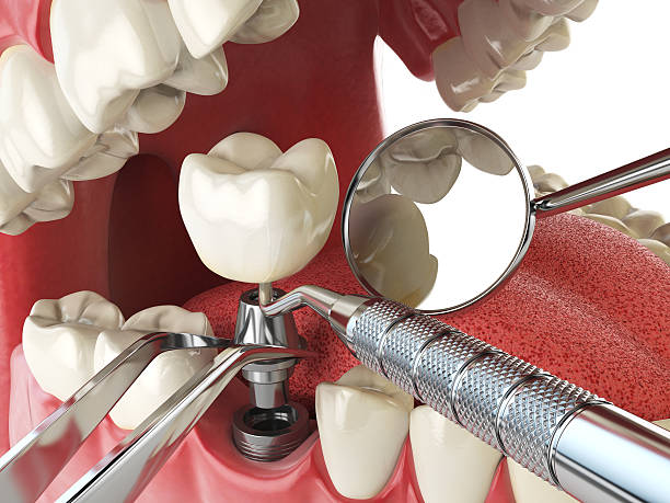 Best Emergency Gum Treatment in Rock Hill, MO